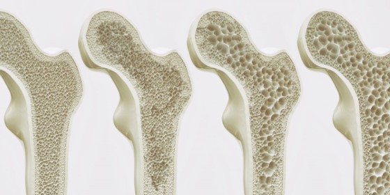Kosti sú prirodzene pórovité, však vplyvom osteoporózy dochádza k zväčšovaniu týchto dutín